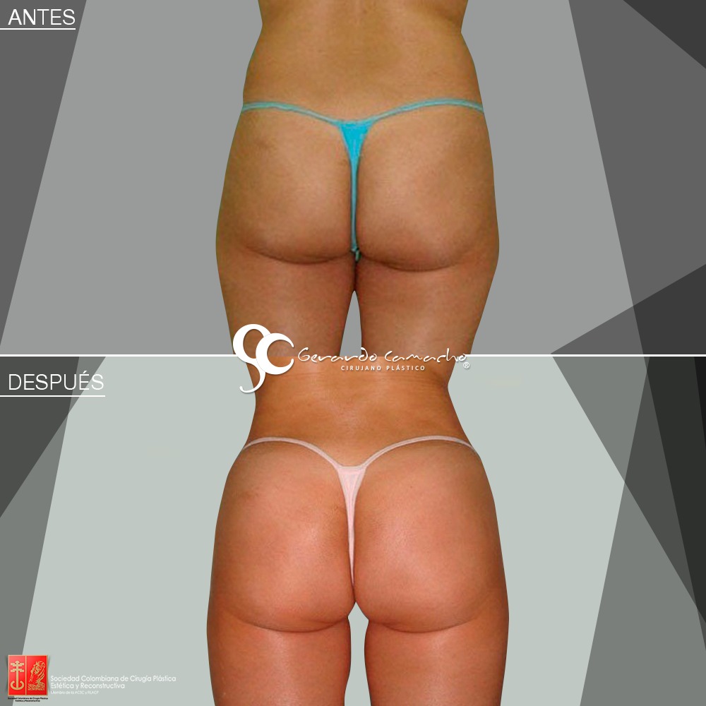 Testimonio gluteoplastia Colombia